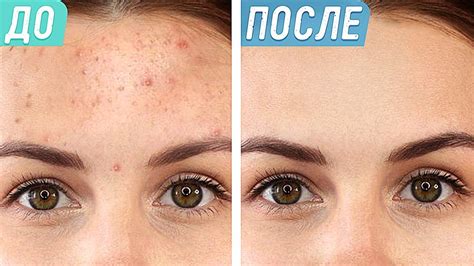 От прыщей к гладкой коже: методы лечения