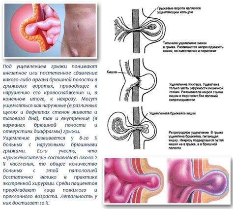 Паховая грыжа: симптомы, причины и лечение