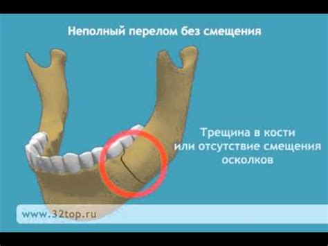 Первая помощь при защемлении челюсти с левой стороны