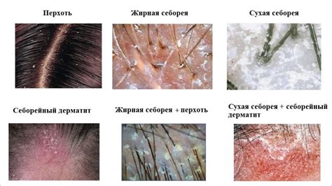 Перхоть из-за грязных волос: что на самом деле происходит в коже головы