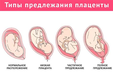 Плацента при полном предлежании: