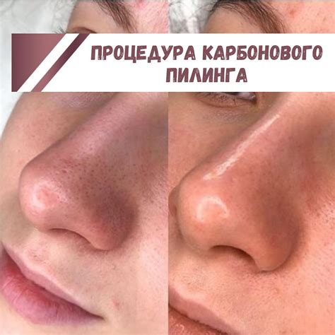 Плюсы записи на процедуру с предварительным бритьем