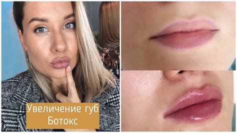 Побочные эффекты при удалении ботокса из губ