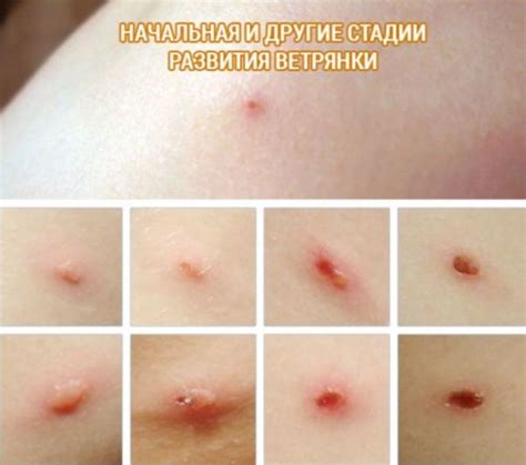 Повторная ветрянка: наши заблуждения