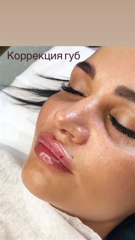 Повышение объема и увлажнение губы
