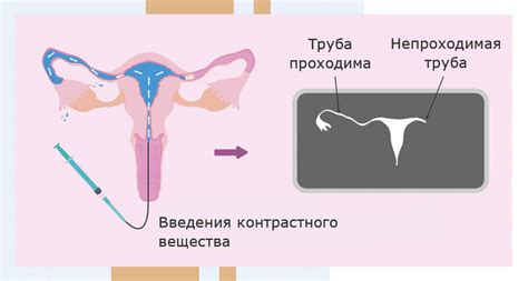 Подготовка к рентгену маточных труб: