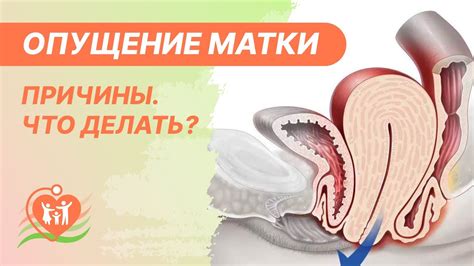 Поддержка беременности при опущении матки