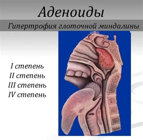 Показания для удаления миндалин у ребенка