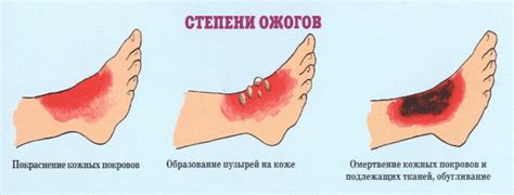 Полезные советы и трюки при забинтовывании ожога с волдырями