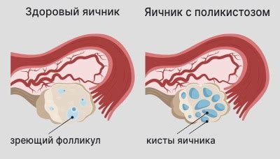 Поликистоз яичников