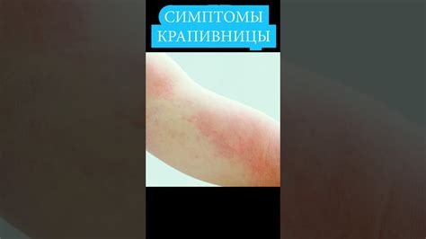 Понимание крапивницы и ее симптомы