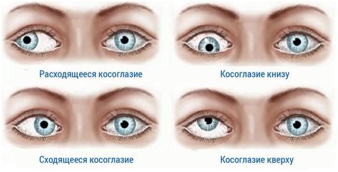 Понятие двоения в глазах