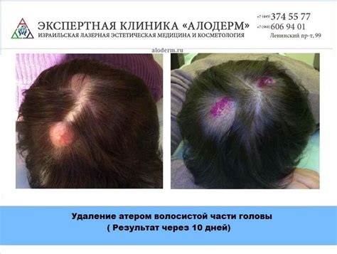 Последствия, возникающие при удалении атеромы на голове