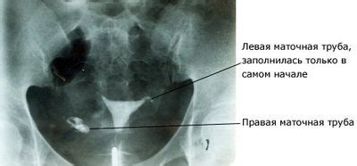 Последствия и преимущества рентгена маточных труб:
