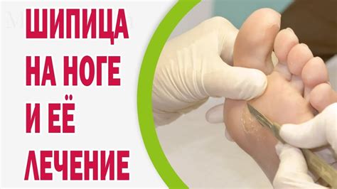 Последствия самостоятельного удаления шипицы