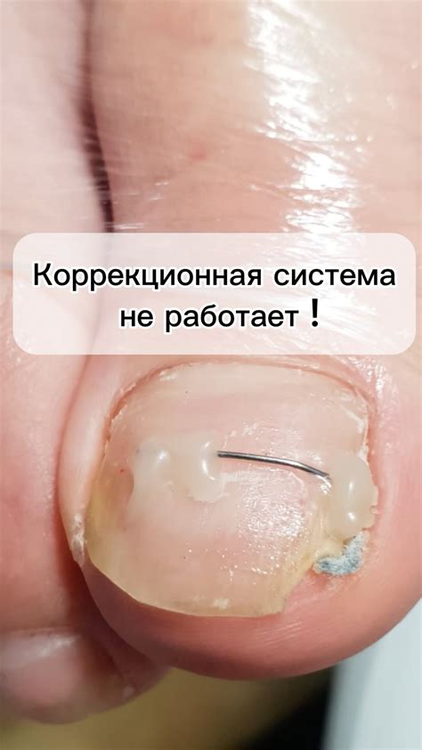 Последующий уход за заклеенным ногтем