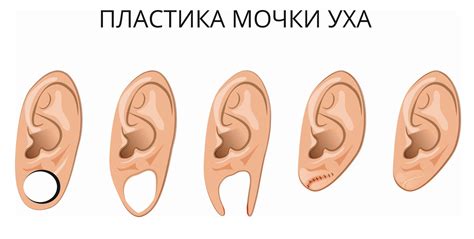 После прокола мочки уха: когда она заживает и советы для быстрого восстановления