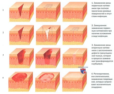 Постепенное переживание и заживление ран