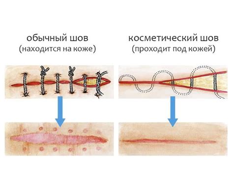 Постепенный возврат к активной жизни после заживления шва