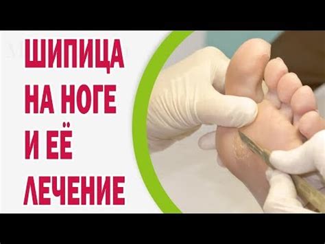 Почему возникают шипицы на ступне