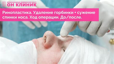 Появление горбинки после ушиба носа