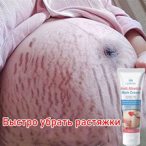 Появление растяжек после родов: причины и профилактика