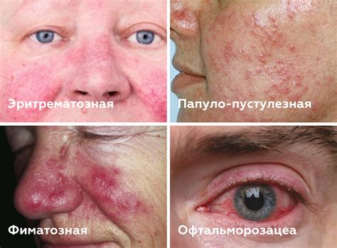 Практическое значение одностороннего покраснения левой щеки