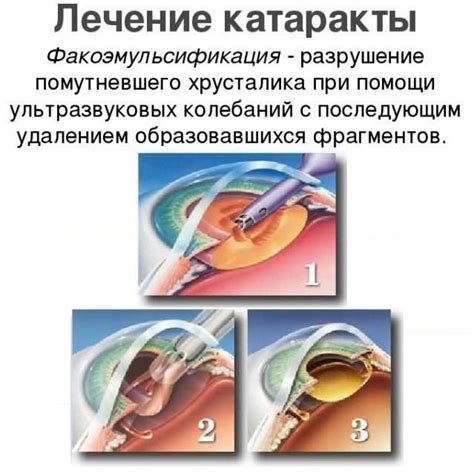 Преимущества лечения катаракты без операции