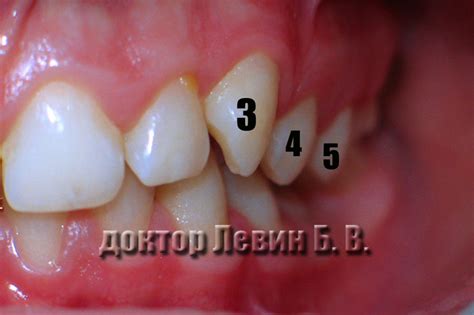 Признаки защемления челюсти с левой стороны