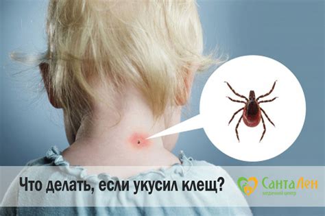 Признаки укуса клеща