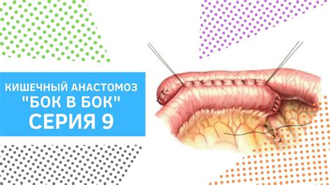 Принцип работы анастомоза бок в бок