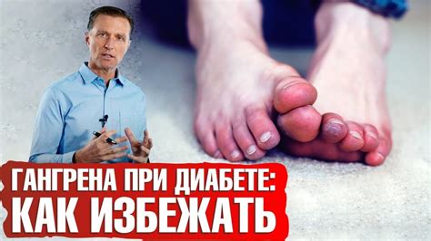 Причины ампутации конечностей при сахарном диабете