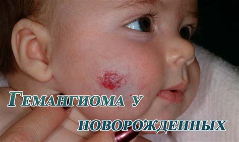 Причины возникновения припухлости век у новорожденных