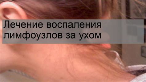 Причины воспаления лимфоузла