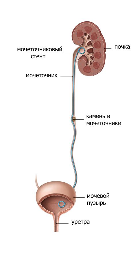 Причины выпадения стента из мочеточника