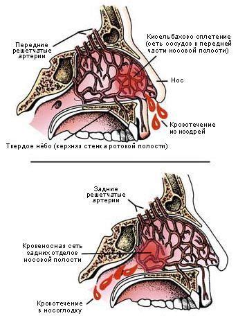 Причины носовых кровотечений при заболеваниях