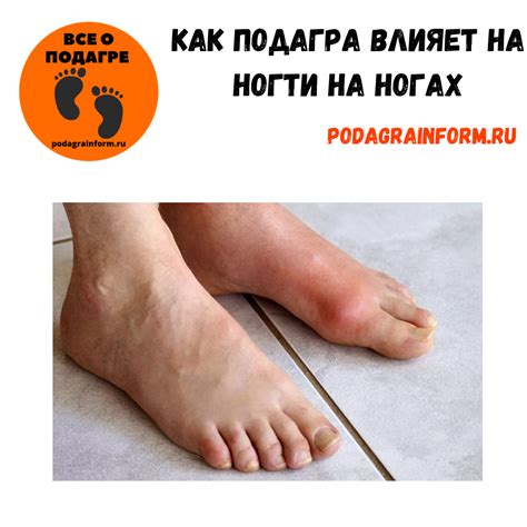 Причины отека стопы при подагре