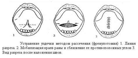 Причины порвания уздечки