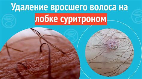 Причины появления волос на лобке