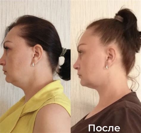 Причины появления второго подбородка