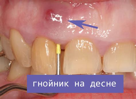 Причины появления гнойника на десне