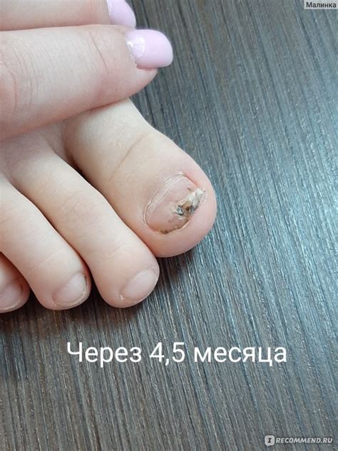 Проблемы после удаления ногтя: о чем важно помнить