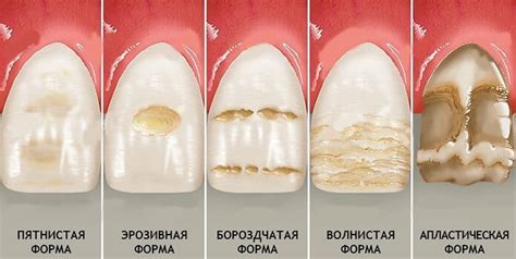 Проблемы с зубами и зубной эмалью