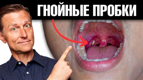 Проверенные методы профилактики гноя в горле
