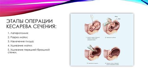 Продолжительность операции кесарева сечения