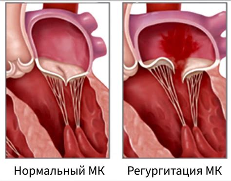 Пролапс митрального клапана