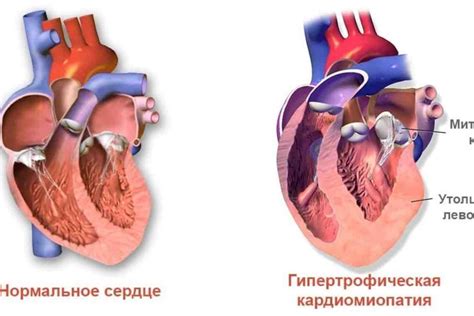 Пролапс митрального клапана и его симптомы