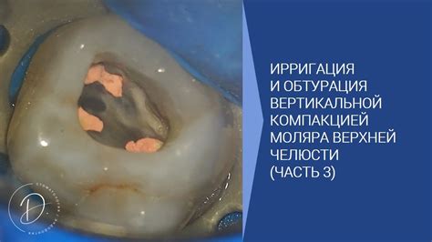 Прорезывание первого моляра верхней челюсти