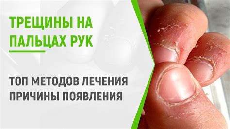 Профессиональные рекомендации при лечении трещины в руке