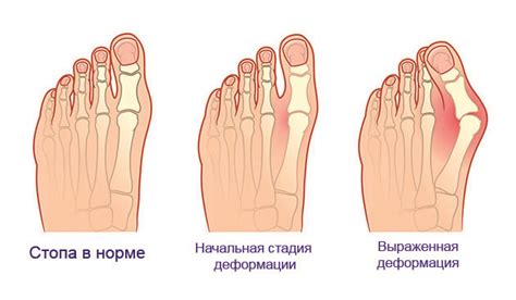 Профилактика проблем с чувствительностью в ноге